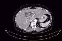 Vàng da người phụ nữ đi khám, phát hiện ca bệnh hiếm, hai ung thư nguyên phát