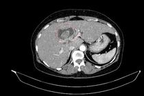 Vàng da người phụ nữ đi khám, phát hiện ca bệnh hiếm, hai ung thư nguyên phát