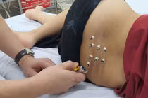 Nhiều sản phụ bí tiểu sau sinh, cách gì khắc phục?