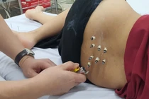 Nhiều sản phụ bí tiểu sau sinh, cách gì khắc phục?