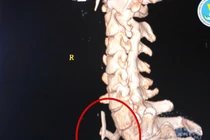 Đau tức vùng cổ ngực, không nuốt được do 4 mảnh xương mắc trong thực quản