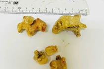 Đau quặn bụng người phụ nữ bị sỏi san hô lớn gây giãn đài bể thận