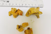 Đau quặn bụng người phụ nữ bị sỏi san hô lớn gây giãn đài bể thận