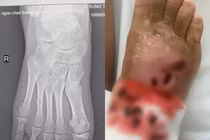 Bó thuốc nam chữa gãy xương, bé 14 tuổi bị hoại tử chi