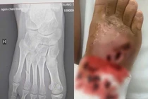 Bó thuốc nam chữa gãy xương, bé 14 tuổi bị hoại tử chi