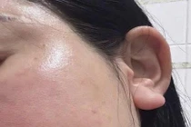 Tiêm meso tại nhà người phụ nữ bị u hạt nhiễm khuẩn nặng