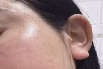 Tiêm meso tại nhà người phụ nữ bị u hạt nhiễm khuẩn nặng