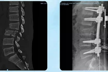 3 cuộc phẫu thuật lớn cứu nam sinh đa chấn thương nguy kịch