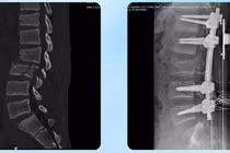 3 cuộc phẫu thuật lớn cứu nam sinh đa chấn thương nguy kịch