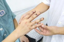 Suýt phải tháo khớp các ngón tay vì nhiễm trùng hoại tử do tự điều trị
