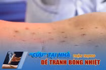 Bỏng khắp lưng vì cứu ngải không đúng kỹ thuật tại thầy lang