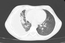 Trẻ 10 tuổi mắc bệnh viêm màng mủ phổi nguy hiểm