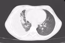 Trẻ 10 tuổi mắc bệnh viêm màng mủ phổi nguy hiểm