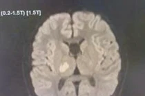 Đang khỏe mạnh, bé 13 tuổi đi lại khó khăn không ngờ đột quỵ