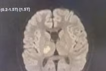 Đang khỏe mạnh, bé 13 tuổi đi lại khó khăn không ngờ đột quỵ