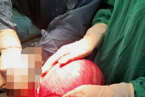 Sản phụ có khối u xơ tử cung nặng 4,2 kg to hơn cả thai nhi