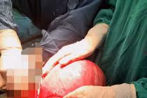 Sản phụ có khối u xơ tử cung nặng 4,2 kg to hơn cả thai nhi