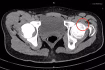 Nam sinh 14 tuổi mọc thêm xương ở khớp háng do hội chứng hiếm gặp