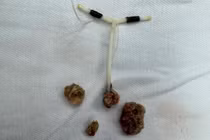 Vòng tránh thai đâm xuyên vào bàng quang tạo thành sỏi lớn