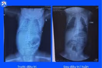 Hành trình hồi sinh cho bé suy hô hấp nặng sau khi chào đời