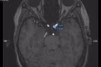 Đau đầu kéo dài phát hiện 'quả bom nổ chậm' phình mạch máu não