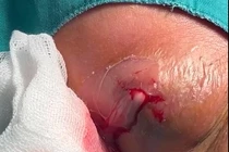 Áp xe sưng to, nhiễm trùng nặng vì tự điều trị khối sưng phồng