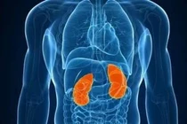 Gần 2000 ca ung thư thận mới mỗi năm, đừng để “cái bẫy thầm lặng” dình dập