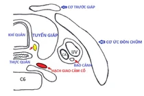Sụp mi mắt có liên quan đến mổ tuyến giáp?