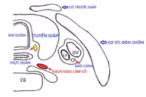 Sụp mi mắt có liên quan đến mổ tuyến giáp?