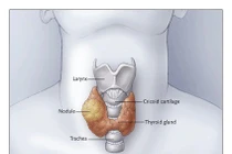 Cách theo dõi bệnh nhân ung thư tuyến giáp nguy cơ thấp
