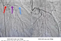 Đau ngực dữ dội, 2 lần ngừng tim liên tiếp do tắc mạch máu chính