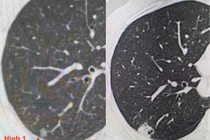 Tình cờ chụp CT, 1 tuần 3 người phát hiện ung thư phổi