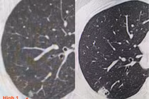 Tình cờ chụp CT, 1 tuần 3 người phát hiện ung thư phổi