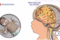 Trẻ sơ sinh 20 ngày tuổi viêm não mô cầu, thủng ruột