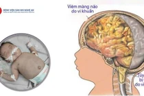 Trẻ sơ sinh 20 ngày tuổi viêm não mô cầu, thủng ruột