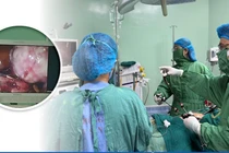 Bóc đa u xơ tử cung lớn kèm nội mạc tử cung dính ruột do không điều trị