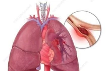 Nguy kịch do thuyên tắc phổi vì dùng thuốc tránh thai kéo dài 10 năm