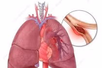 Nguy kịch do thuyên tắc phổi vì dùng thuốc tránh thai kéo dài 10 năm