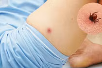 Sốt cao, ho nhiều không ngờ hỏng gan, phổi do mò đốt