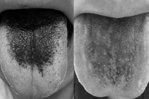 Nhiều người đi khám lưỡi đen bất thường, lo sợ bệnh nguy hiểm