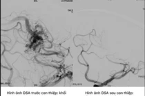 Tưởng đau đầu bình thường, cô gái 25 tuổi bị xuất huyết não