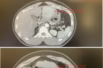 Đau bụng quanh rốn, chàng trai 35 tuổi không ngờ u gan chảy máu nguy kịch