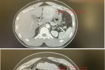 Đau bụng quanh rốn, chàng trai 35 tuổi không ngờ u gan chảy máu nguy kịch