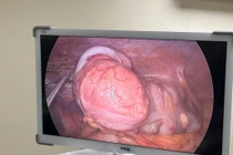 Cắt khối u nhầy ruột thừa kích thước lớn cho cụ ông 72 tuổi