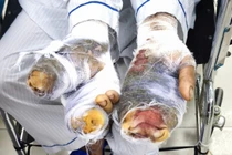 Cụ bà bị chó nhà tấn công cắn nát 2 bàn tay