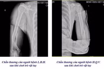 Bác sĩ cảnh báo nhiều ca gãy xương cánh tay khi chơi vật tay