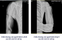 Bác sĩ cảnh báo nhiều ca gãy xương cánh tay khi chơi vật tay