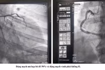 Cấp cứu kịp thời bệnh nhân nhồi máu cơ tim cấp