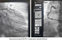 Cấp cứu kịp thời bệnh nhân nhồi máu cơ tim cấp