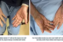 Tay lạnh, đau dữ dội, cụ bà 97 tuổi tắc mạch chi cấp do cục máu đông